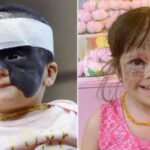 Luna Fenner, la niña estadounidense que nació con “la máscara de Batman”, regresa a Rusia a continuar con su tratamiento reconstructor de la piel de su rostro
