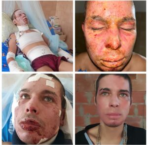 Vídeo: “Cuando sobrevives a lo que podría ser tu muerte”: el artista venezolano DC ART escapa con vida de una explosión e incendio que le quemó la cara y parte de su cuerpo y se repone para seguir haciendo lo que más ama, su música